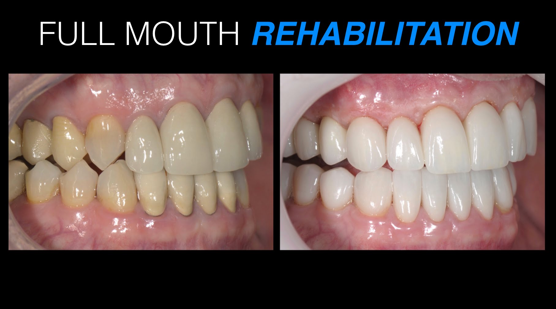 FULL MOUTH REHABILITATION Orasurge dental clinic